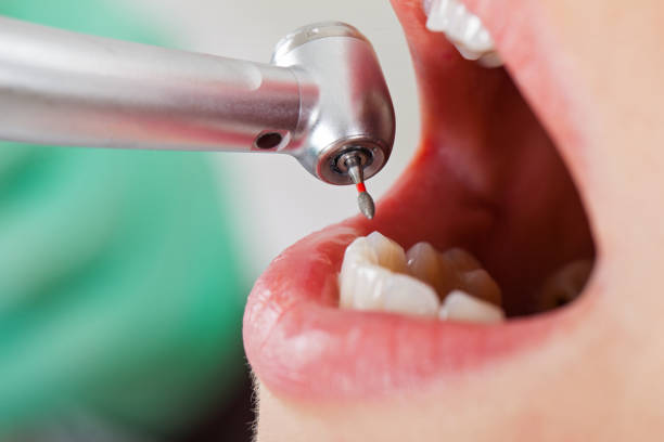 Best Teeth Whitening  in Rayre, MO